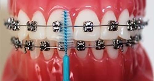 Cepillado de brackets galeria 2