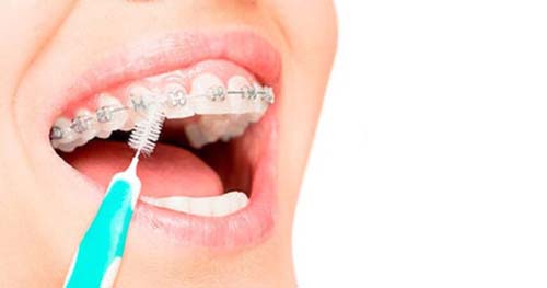 Cepillado de brackets galeria 3