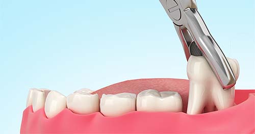 Extraccion galeria 2