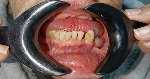 Extraccion galeria 4